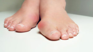 Hallux valgus douloureux au pied