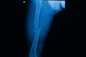 Fracture du fémur