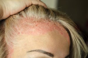 Psoriasis du cuir chevelu