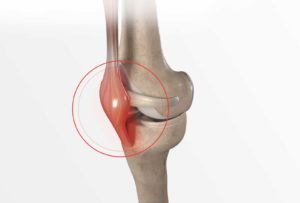Rupture de tendon rotulien du genou