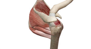 Rupture du tendon du supra-épineux
