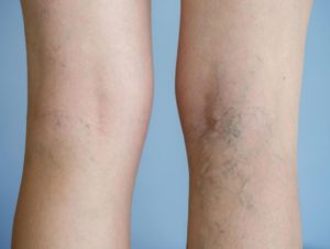 Veines variqueuses